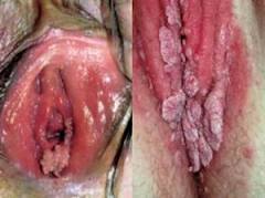 Gambar kutil kelamin di vagina